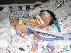 Jake's second heart surgery. 10 months old